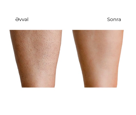 Candela Mini GentleLase